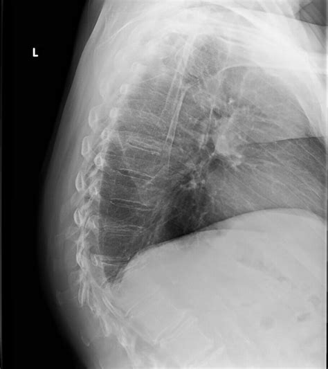 scalene compression test|do thoracic compression fractures heal.